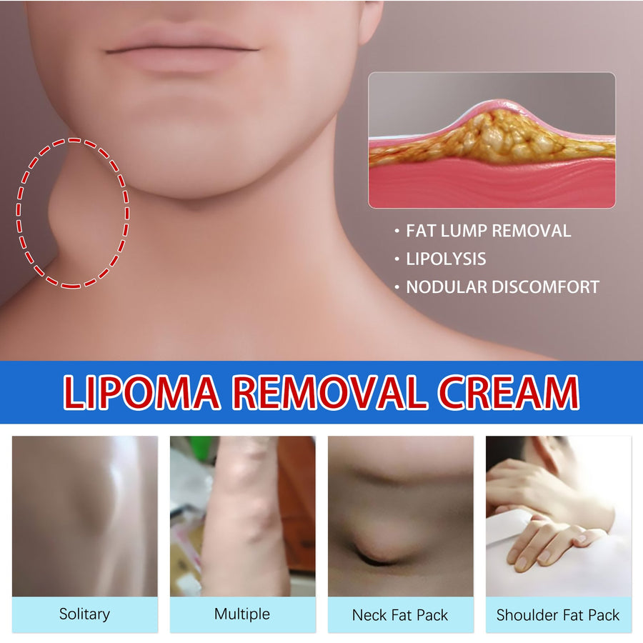South Moon Lipoma Cream — Dissolves Benign Lumps Naturally