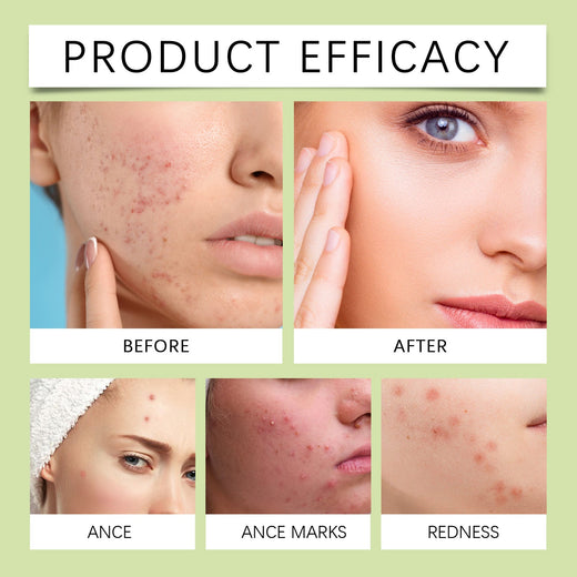 Invisible Acne Patches That Absorb Oil Overnight