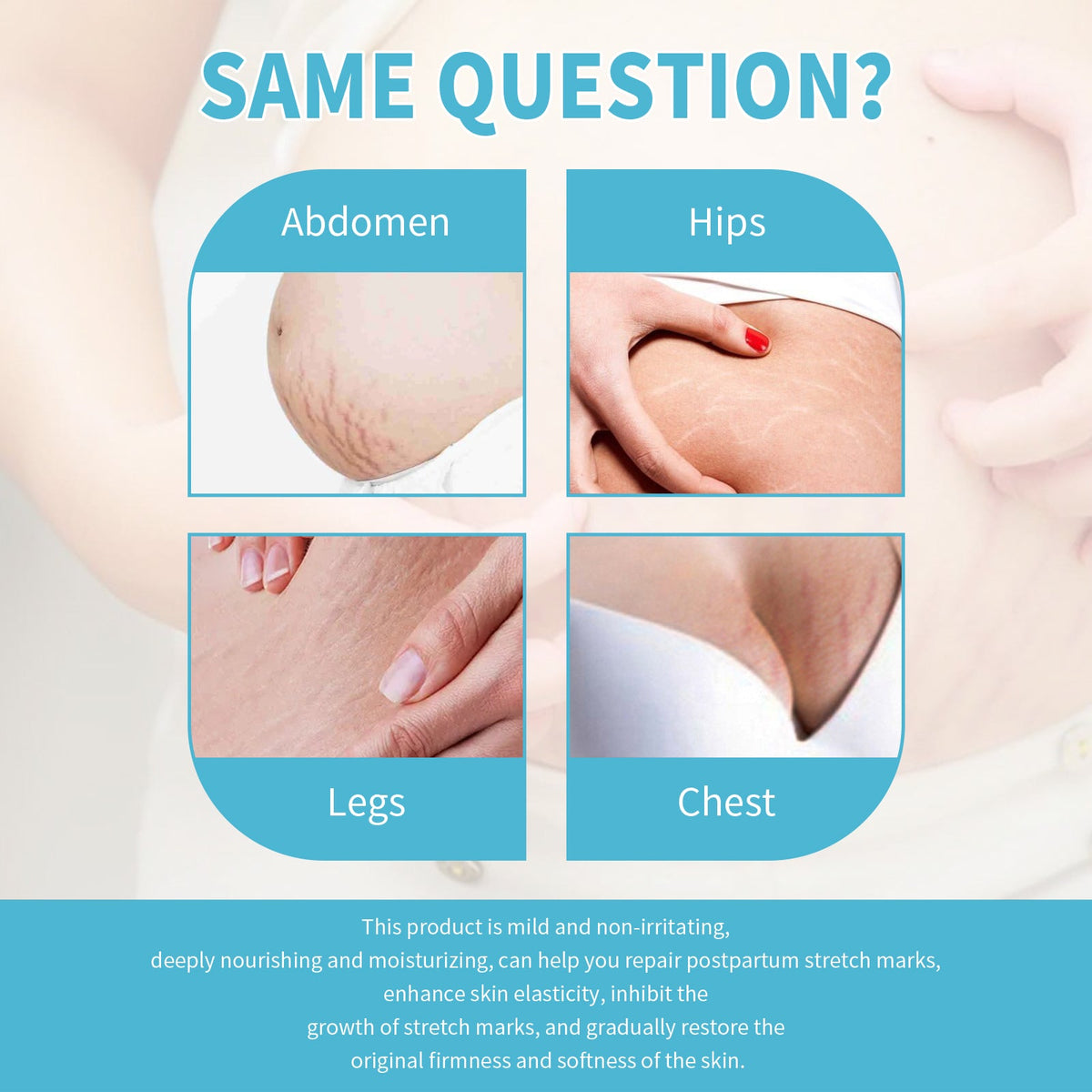 Stretch Mark Repair Cream for Pregnancy Skin Recovery