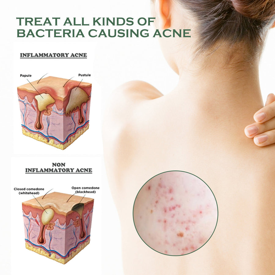 Body Acne Spray for Back, Chest & Shoulder Breakouts