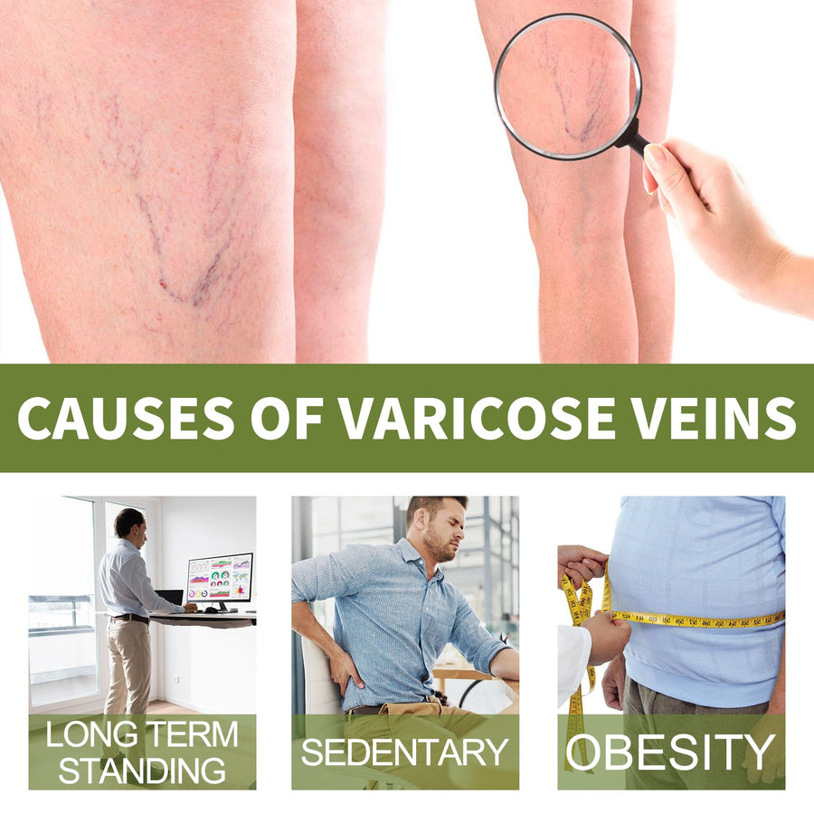 Varicose Vein Therapy Cream – Leg Relief & Spider Vein Repair