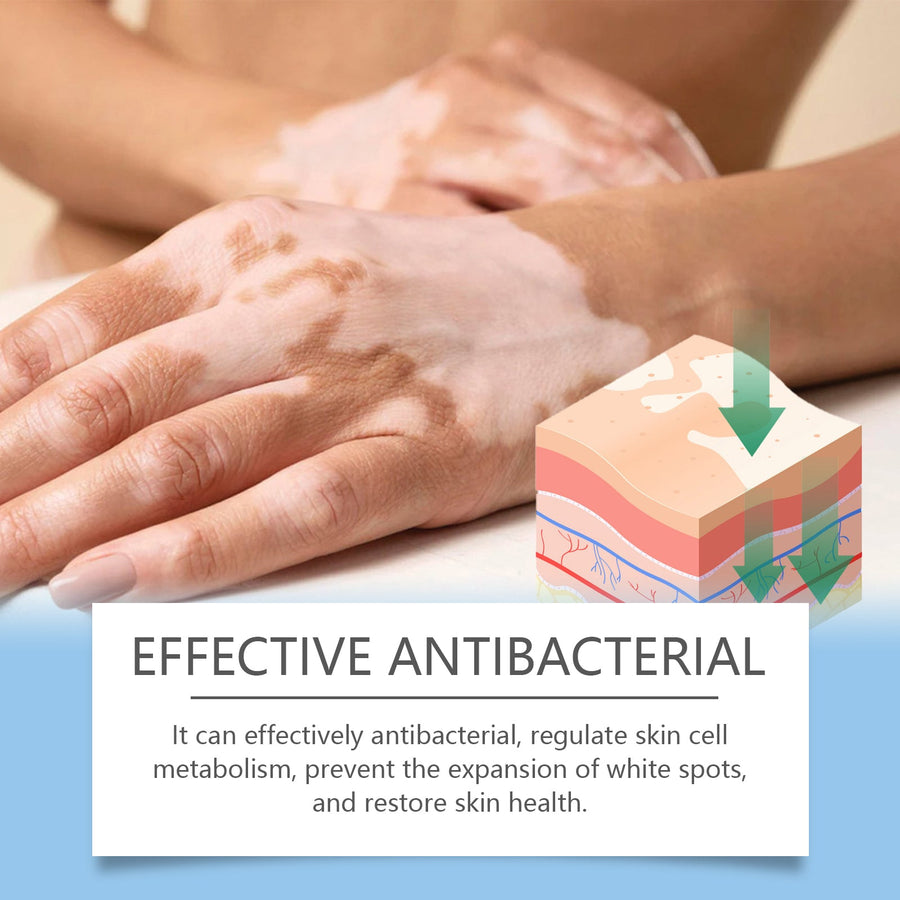 Vitiligo Cream — Stimulates Pigment Restoration & Deep