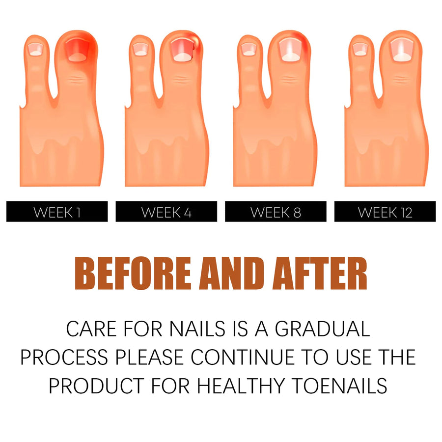 Nail Treatment Oil — Relieves In‑Growing Toenails