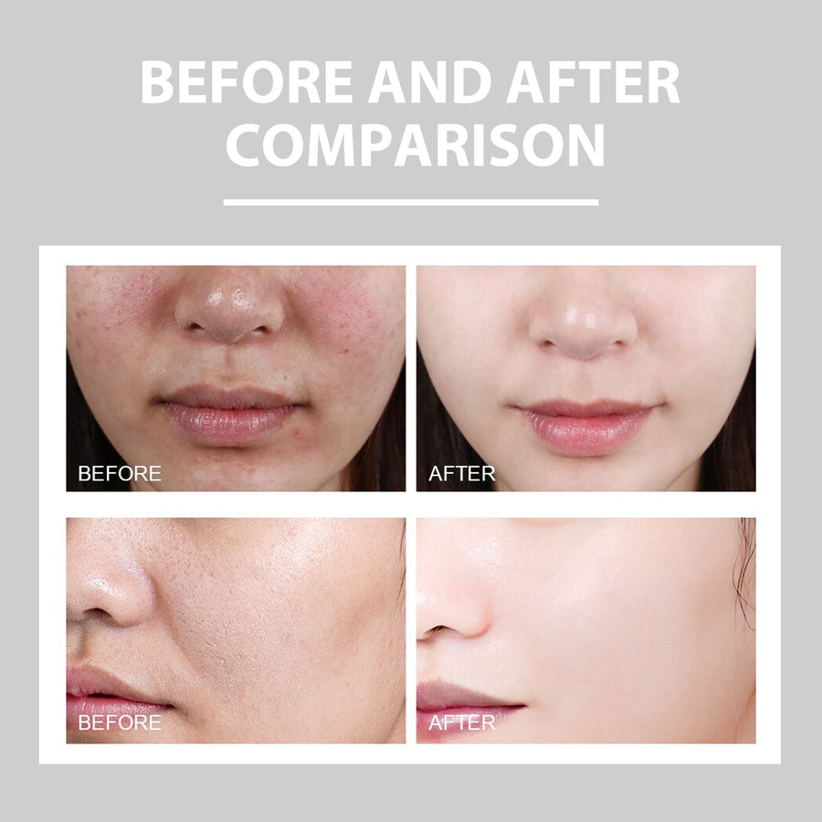 Hydrating Cream Hydrating And Lightening Facial Acne Repair