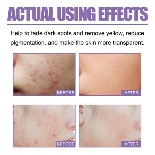 Lavender Acne Soap Bar For Oily Skin Pore Control