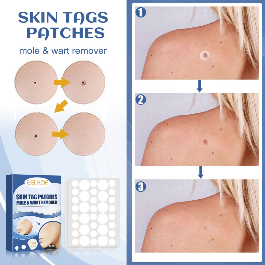 Skin Tag Patches – 144 Gentle Mole & Wart Removal Patches