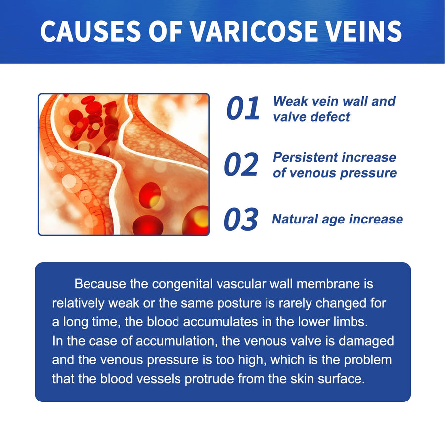 Varicose Vein Cream — Visible Vein Reduction in 2 Weeks