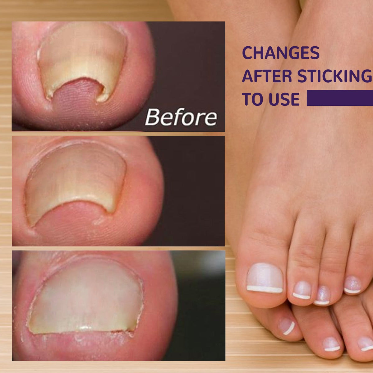 Elastic Toenail Correction Patch for Ingrown Nail Relief