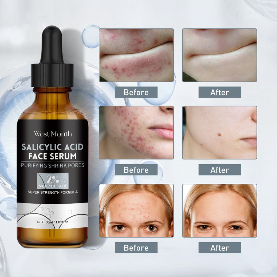 Salicylic Acid Facial Essence, Lighten Acne Mark Repair Hydr