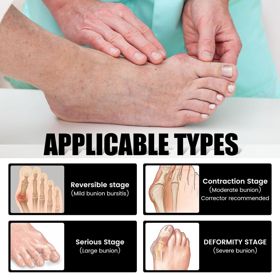 Anti-Bunions Compression Socks — Visible Reduction in 8 Weeks