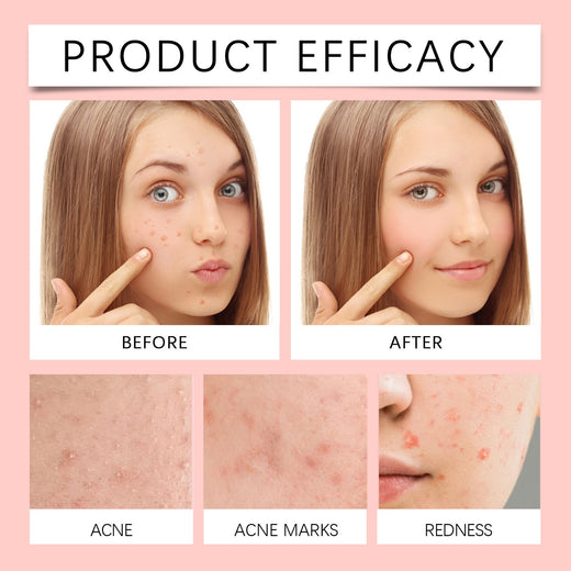 Invisible Acne Patches That Visibly Shrink Blemishes Overnight