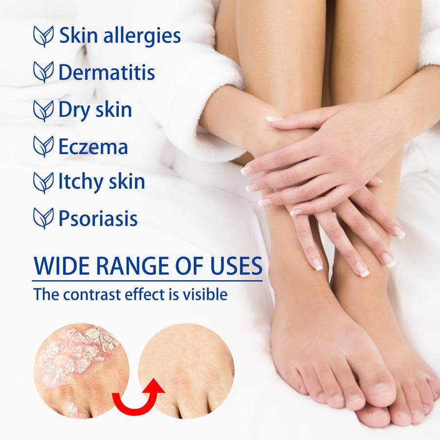 Psoriasis Herbal Ointment — Clinically‑Proven Itch & Plaque