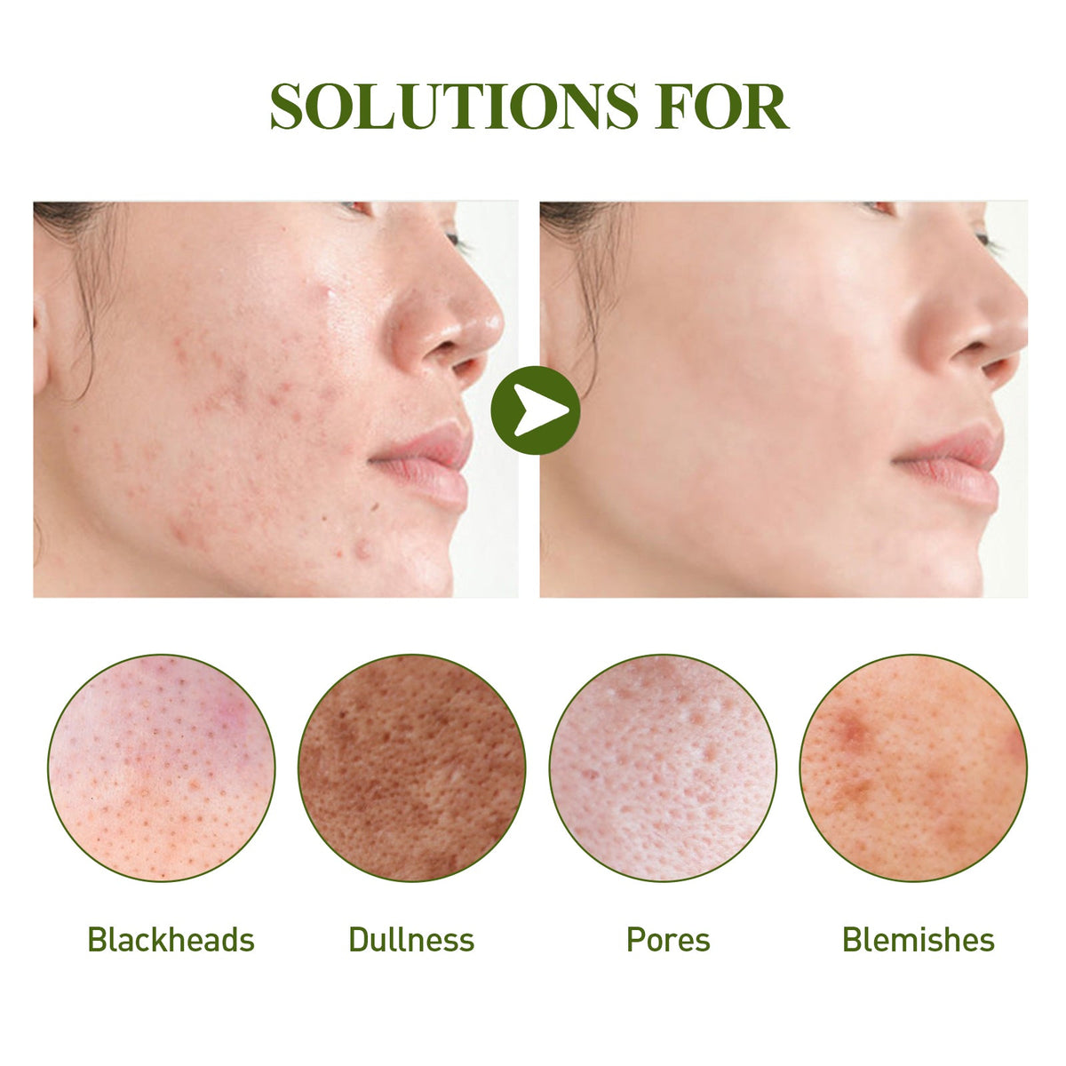 Blackhead Removing Serum & Strip Kit for Clear Pores