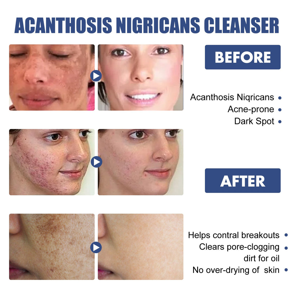 Acanthoderm Face Cleanser for Oily, Breakout-Prone Skin