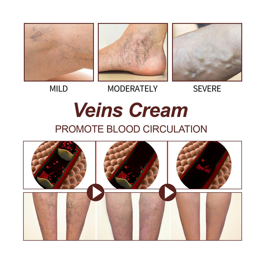 Leg Vein Treatment Cream — Fast At-Home Relief for Varicose