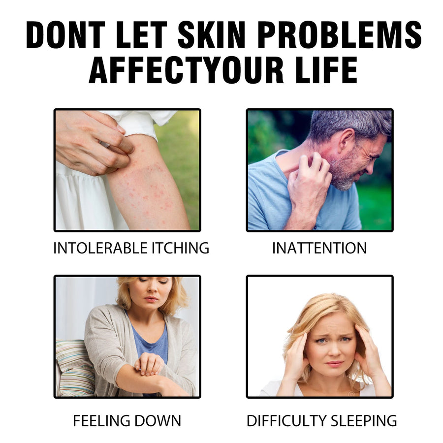 Herbal Psoriasis Spray for Hands & Feet Relief