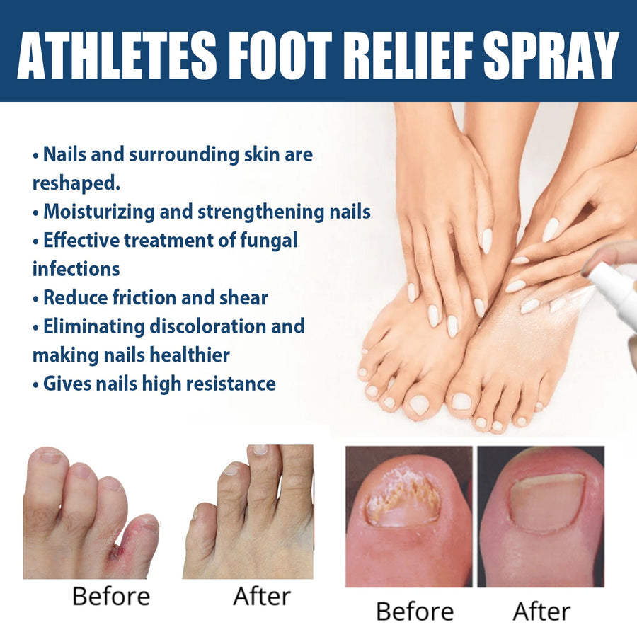 Athlete’s Foot Spray - Natural Relief for Itchy, Gray Nails