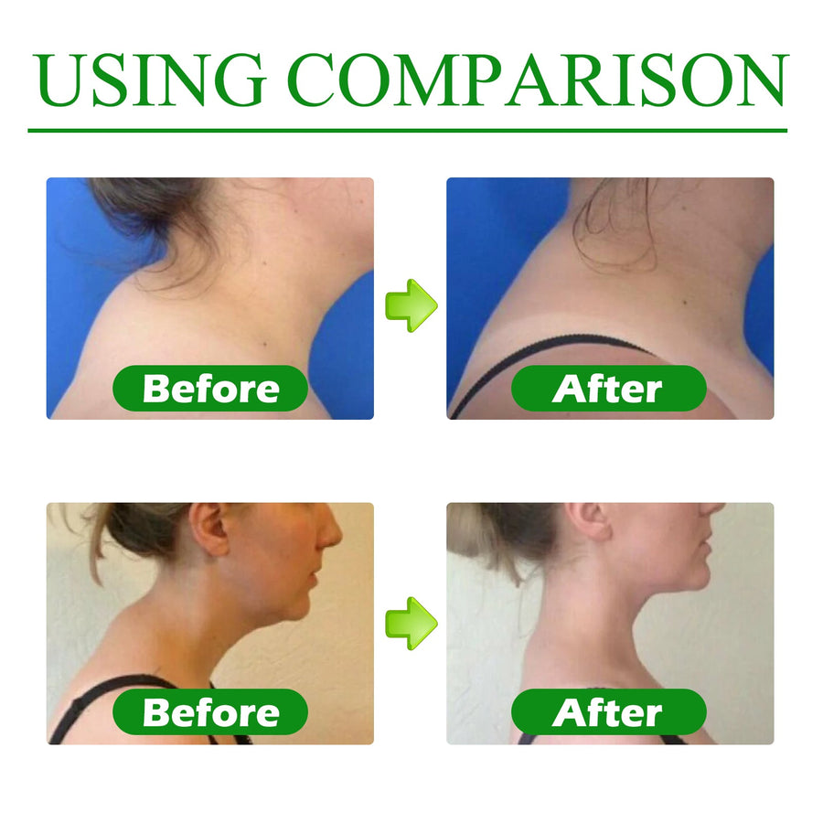 Buffalo Hump Relief Patches — Non-Surgical Spine & Neck