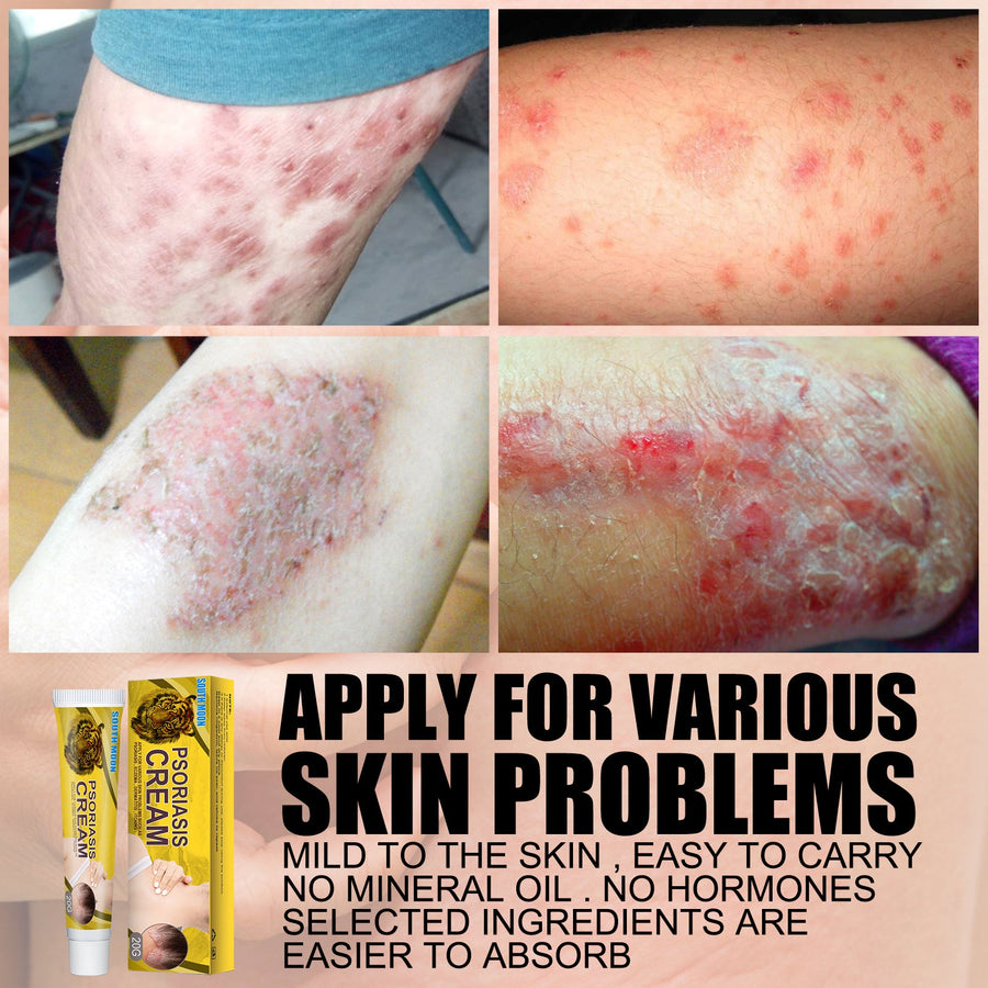 Ringworm Treatment Cream — Visible Skin Repair in Days