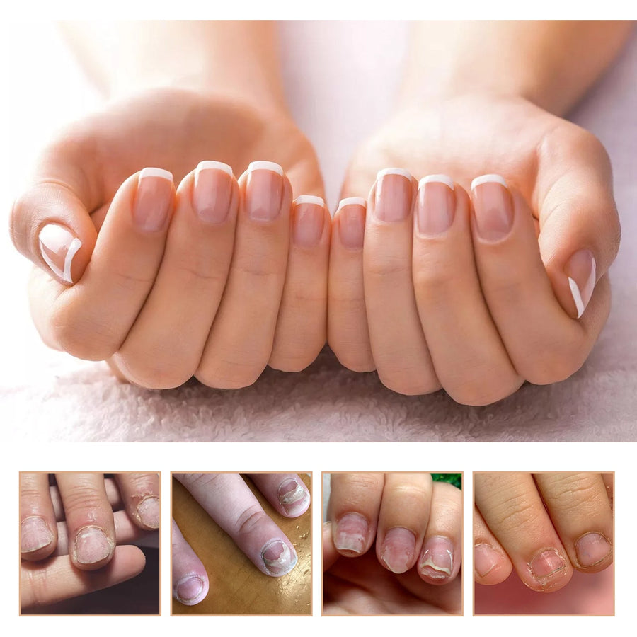 Nail Repair Gel for Damaged, Discolored Toenails