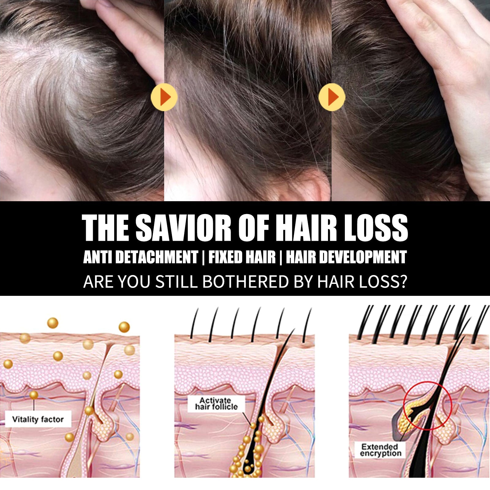 Male pattern baldness progression with hairline marked by dotted line, showing improvement in coverage and reduced recession