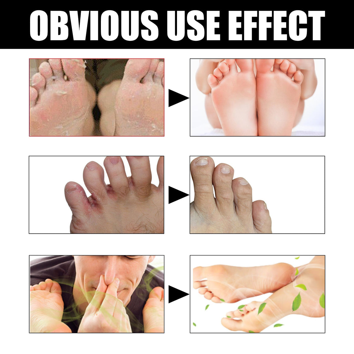 Foot Deodorant Cream for Odor, Itch & Peeling Relief