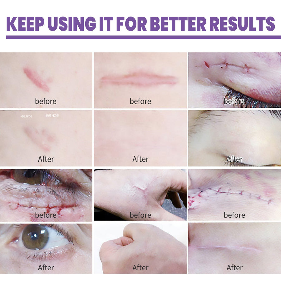Skin Repair Cream — Visibly Fade Acne Scars & Stretch Marks