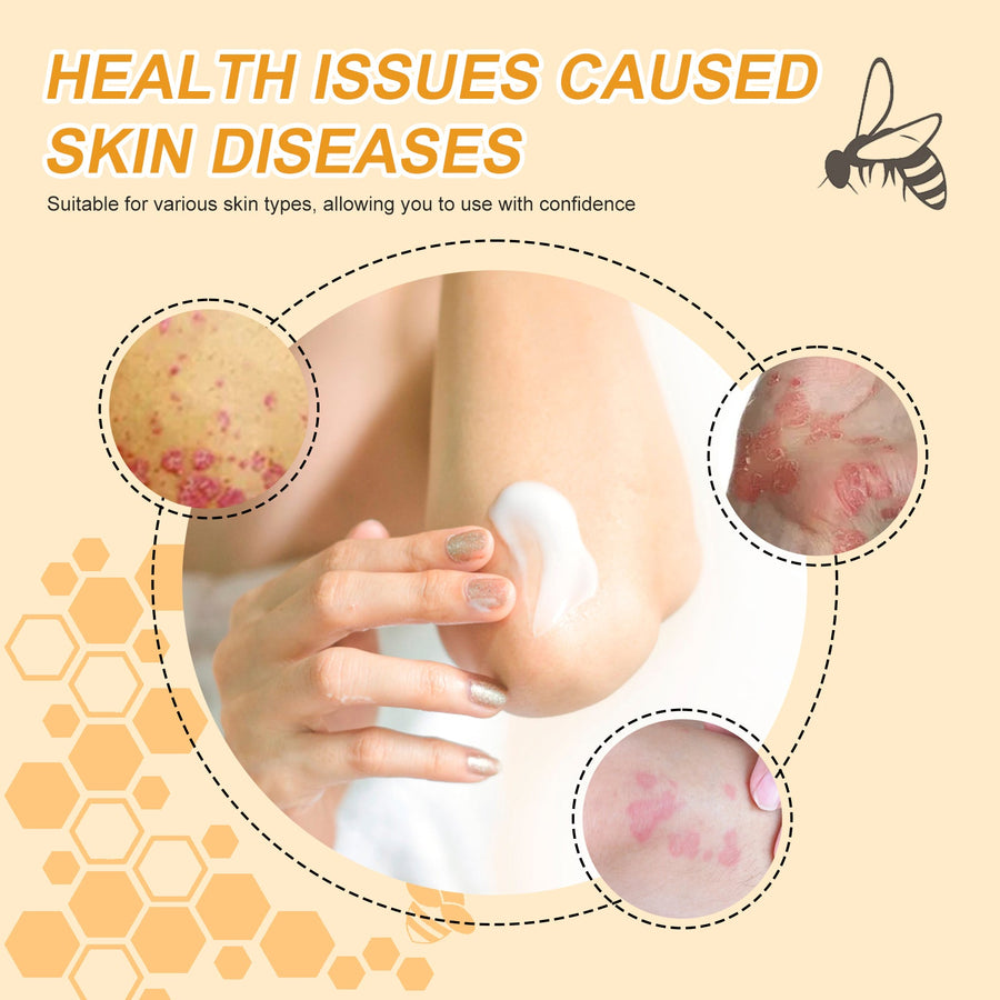 Psoriasis Cream With Bee Venom For Itch Relief