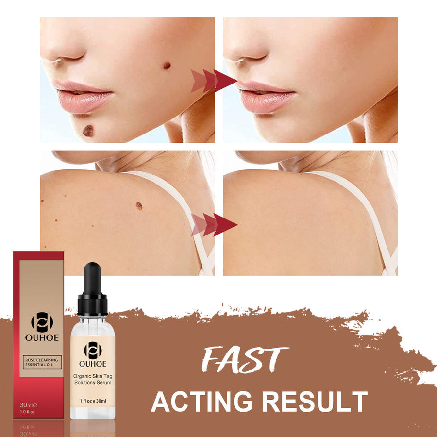 Removing Nevus Liquid Removing Nevus Cream Repair Removing N