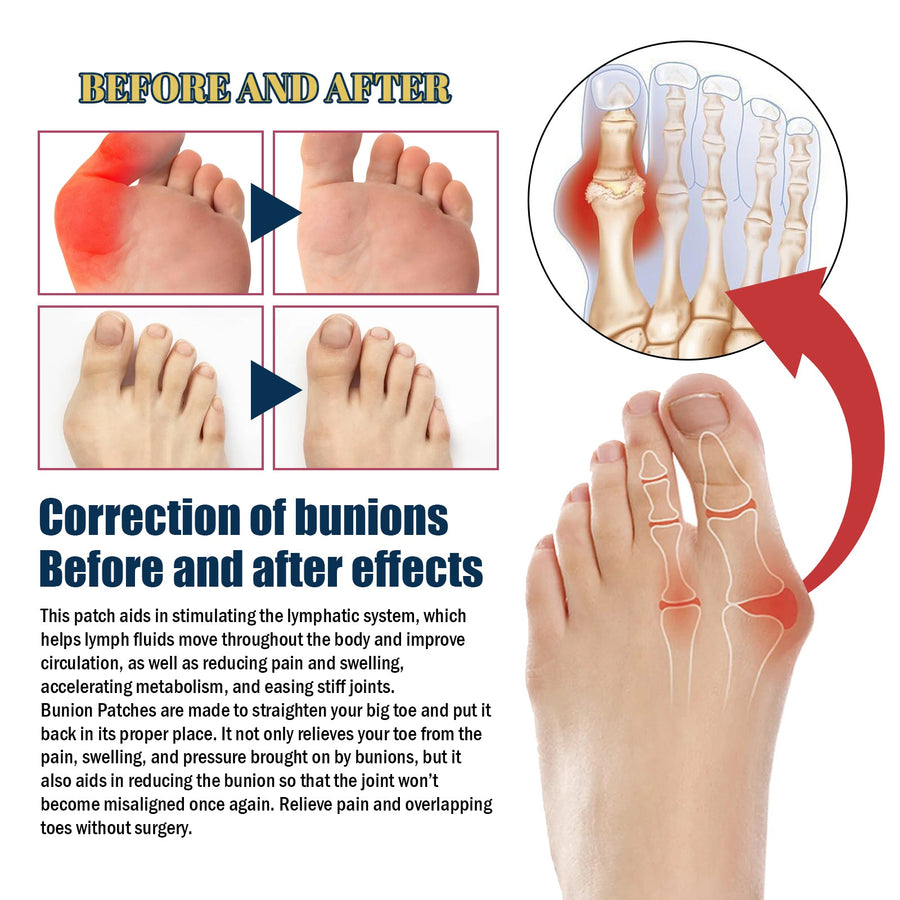 Bunion Relief Patch Set — Fast Pain & Swelling Relief, Wear