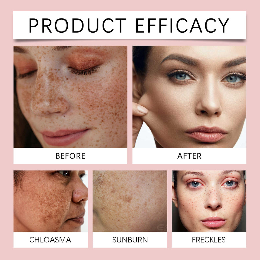 Freckle Serum with Niacinamide for Even Skin Tone