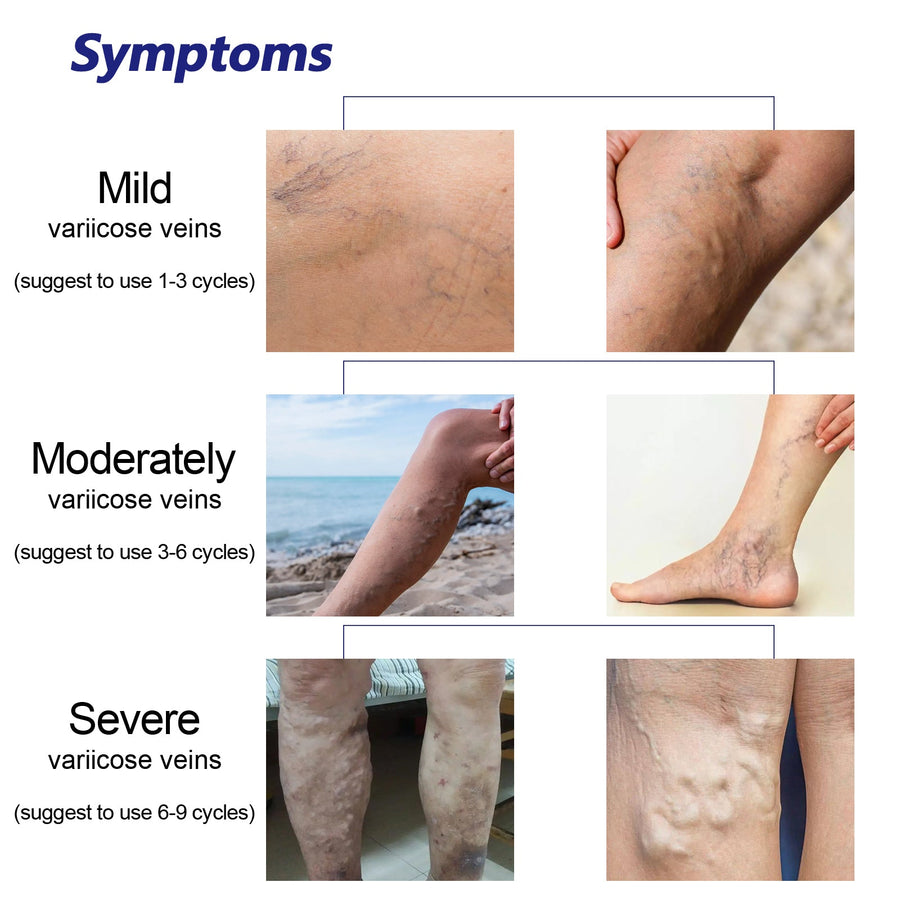OUHOE Varicose Vein Spray — 60% Improvement in 4 Weeks