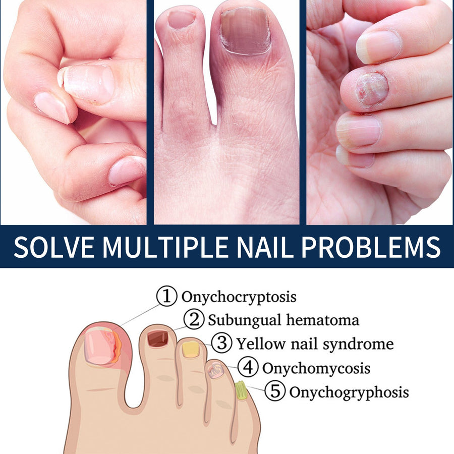 Nail Repair Essence Pen — Restores Healthy Nails from