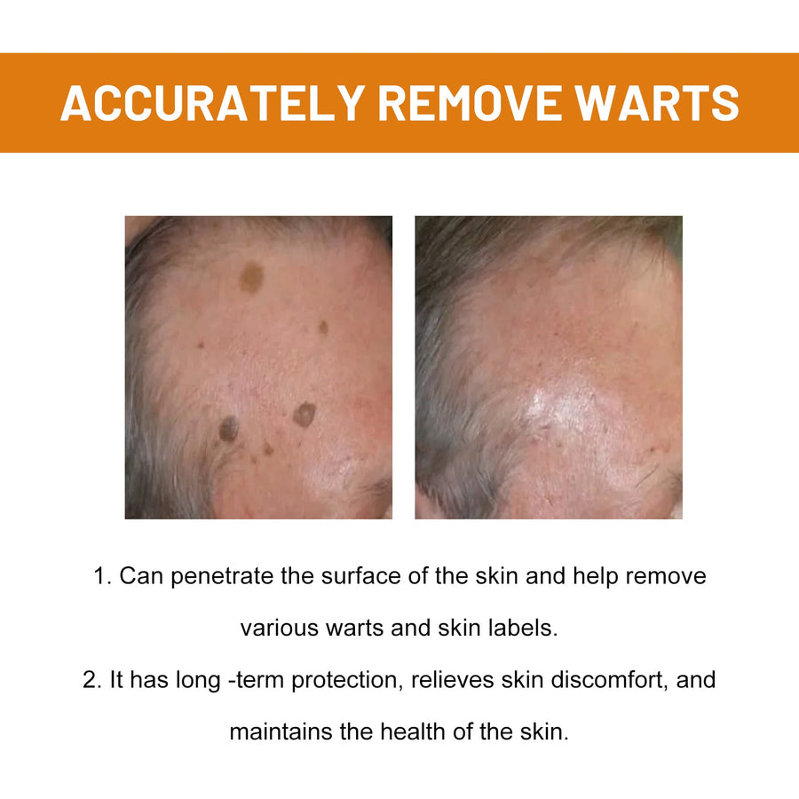 Bee Venom Wart Treatment Spray — Clear Skin in 8 Weeks