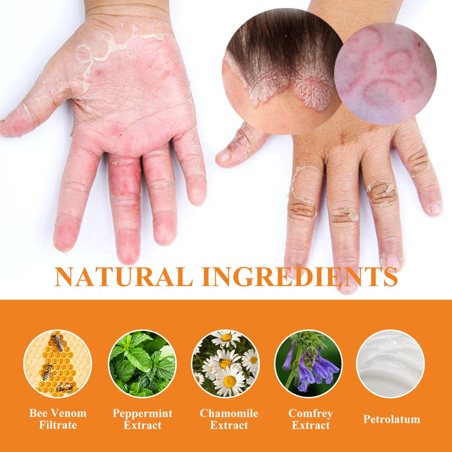 Bee Venom Psoriasis Cream, Relieve Itchy Skin Repair Hand Mo