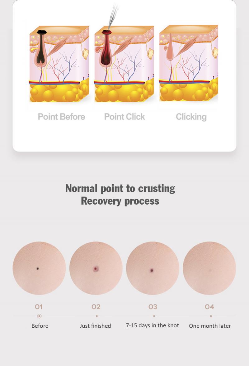 Plasma Pen Skin Care Applicator
