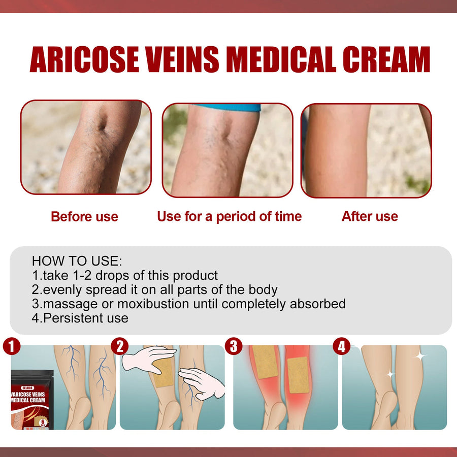 Varicose Vein Cream & Patches — Smoother Legs, Less Swelling