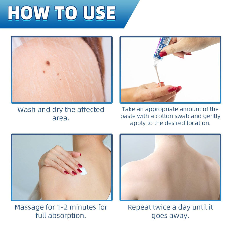 Topical Wart Removal Cream for Gentle At-Home Care