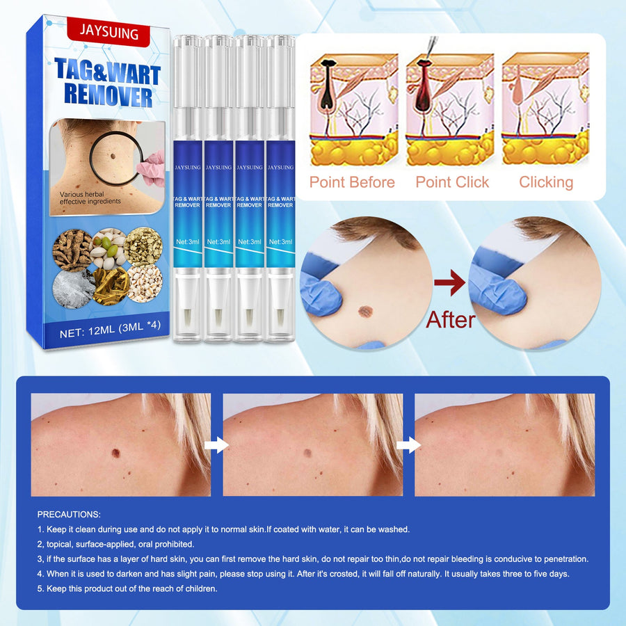 Wart Remover Pens for Targeted At-Home Skin Care
