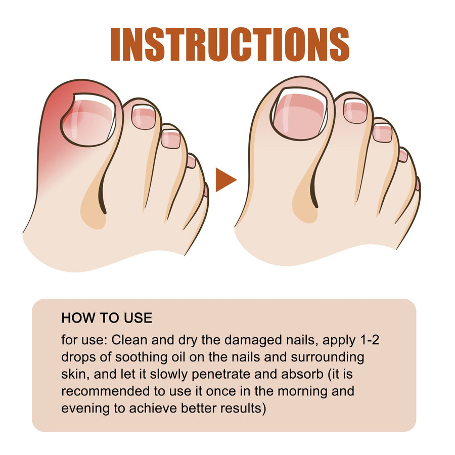 Nail Treatment Oil — Relieves In‑Growing Toenails