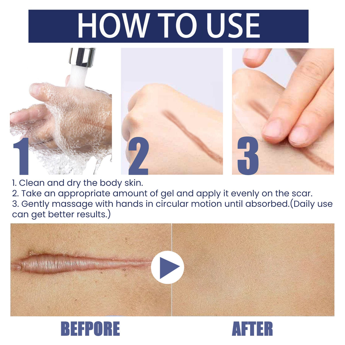 Advanced Silicone Scar Gel - Fades New & Old Scars Visibly