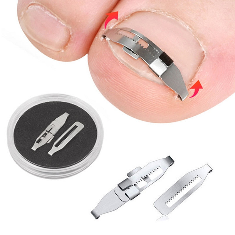 Ingrown Toenail Corrector Brace, Discreet Steel Lift