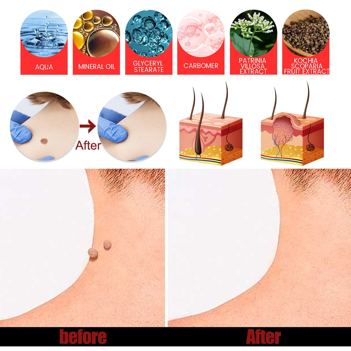 Wart Remover Cream 20g, Gentle Herbal Skin Treatment