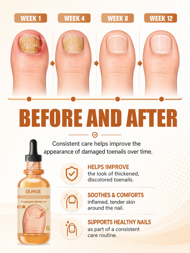 Nail Treatment Oil — Relieves In‑Growing Toenails