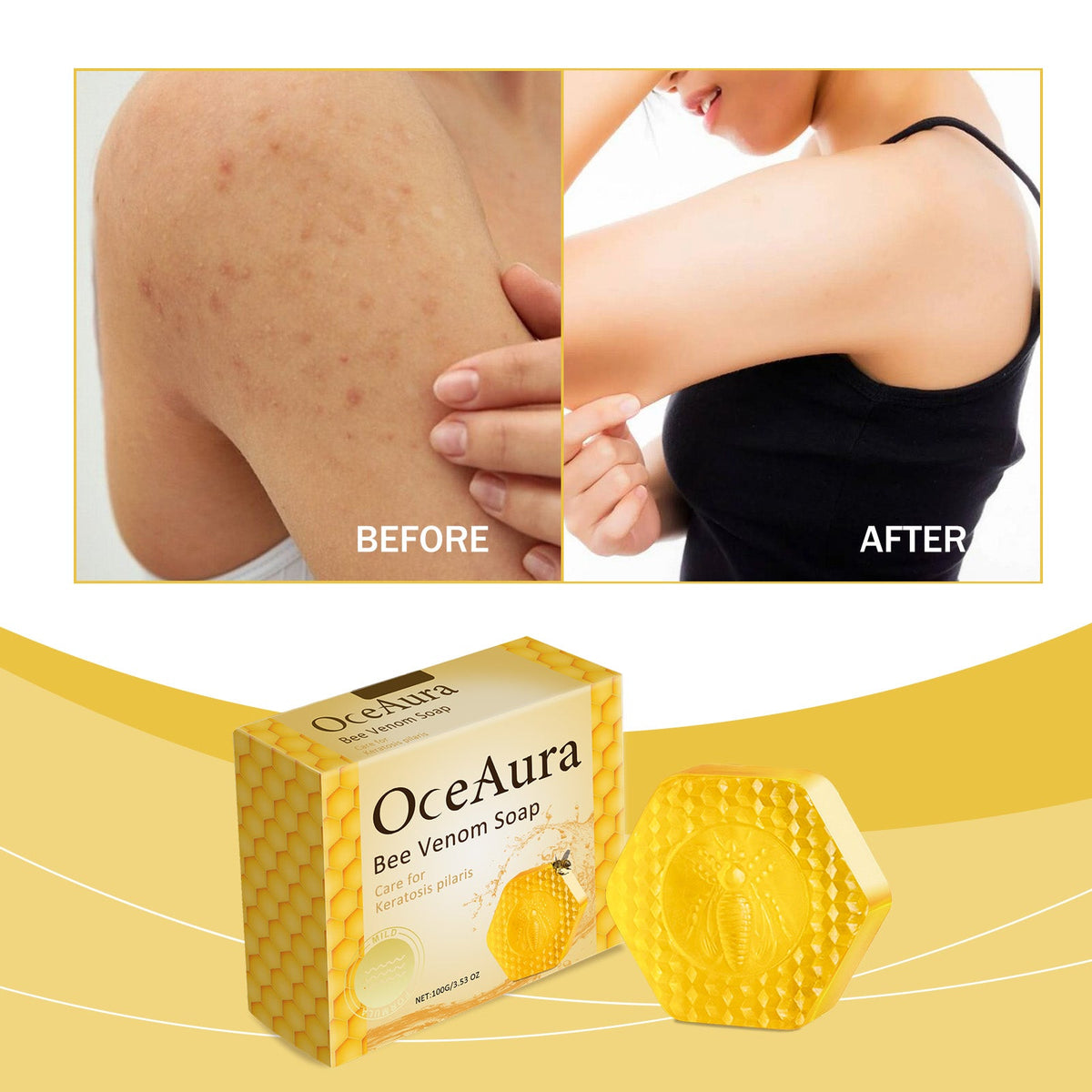 Bee Venom Body Soap for Bumpy Skin & Keratosis Pilaris