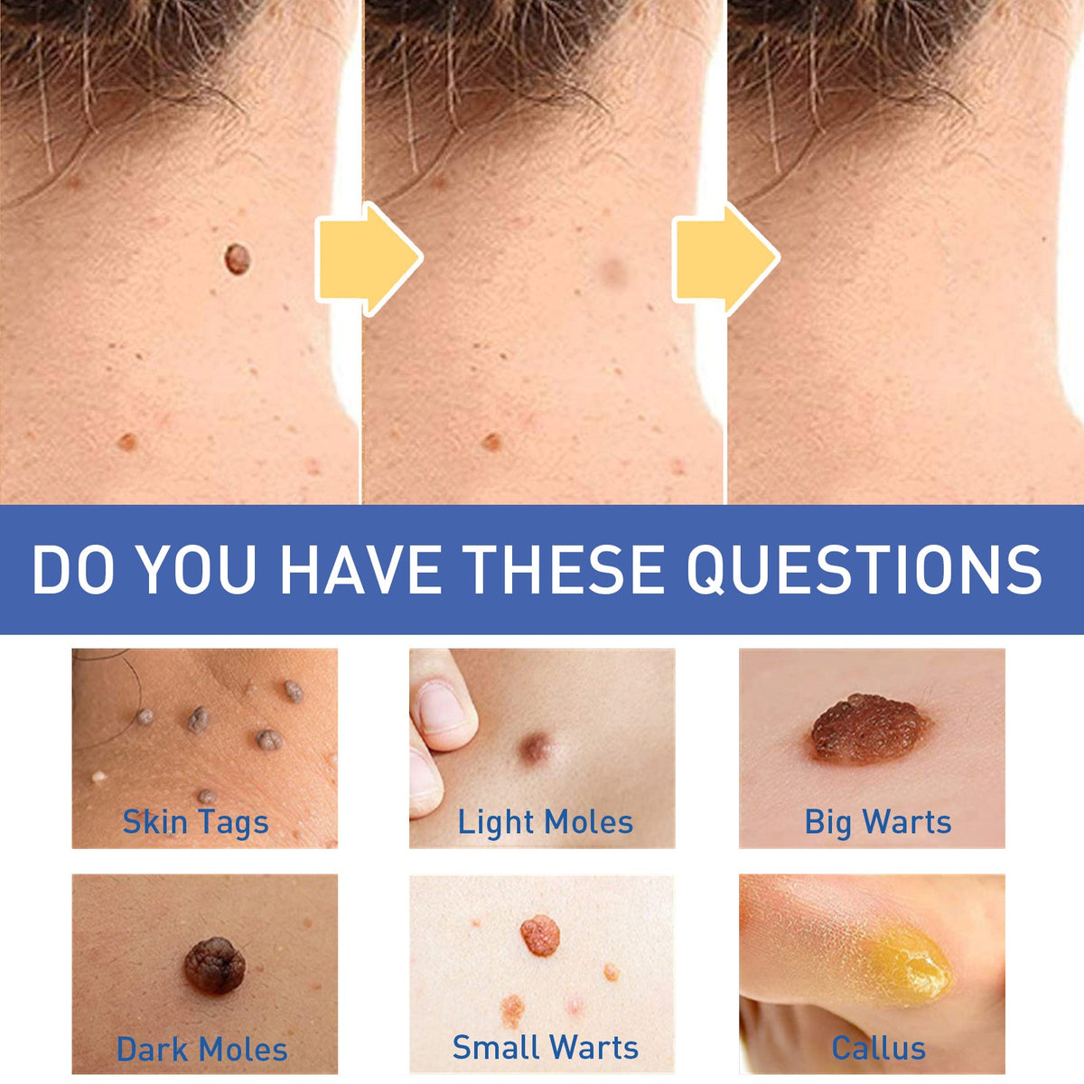 Herbal Wart and Skin Tag Remover Cream with Tea Tree Oil